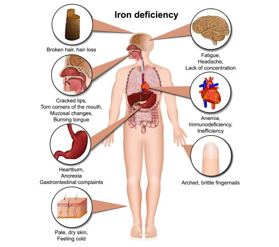 Iron deficiency